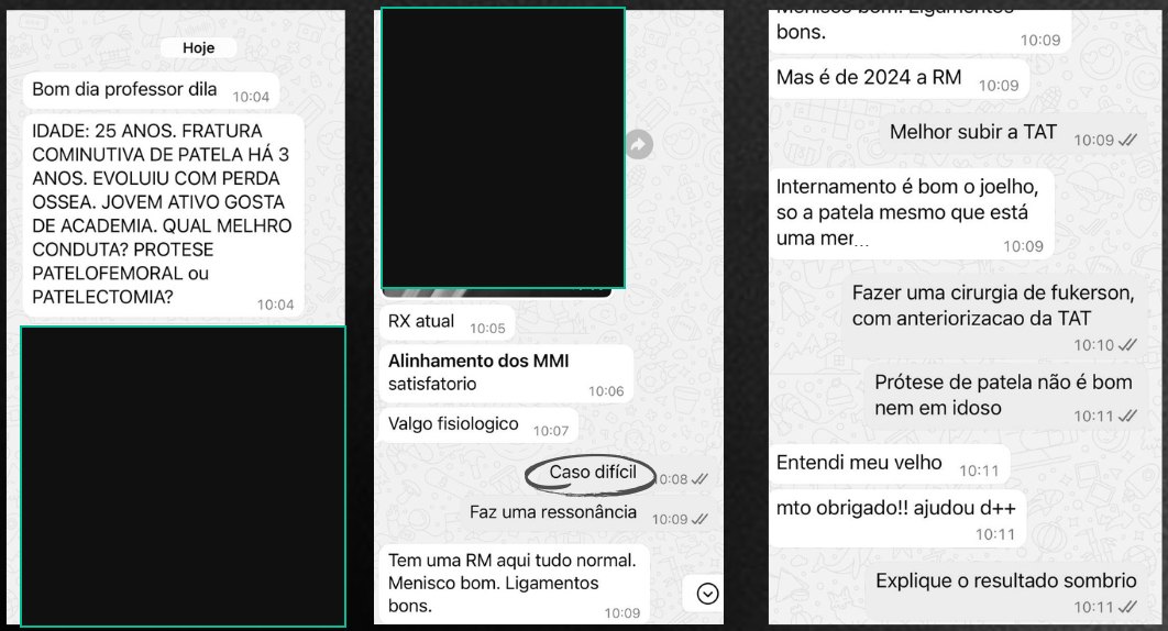 Print da conversa no grupo: um membro pergunta sobre paciente de 25 anos com fratura cominutiva de patela há 3 anos e perda óssea, entre prótese patelofemoral e patelectomia. Dr. Dilamar responde que prótese de patela não é boa nem em idoso e indica cirurgia de Fulkerson com anteriorização da tuberosidade. As radiografias estão cobertas por tarjas.
